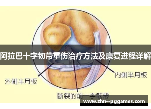 阿拉巴十字韧带重伤治疗方法及康复进程详解 阿拉巴十字韧带重伤治疗方法及康复进程详解